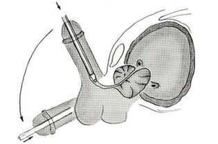 Schéma endoskopické operace zvětšení penisu