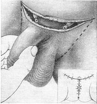 Chirurgické prodloužení penisu vytažením jeho skryté části